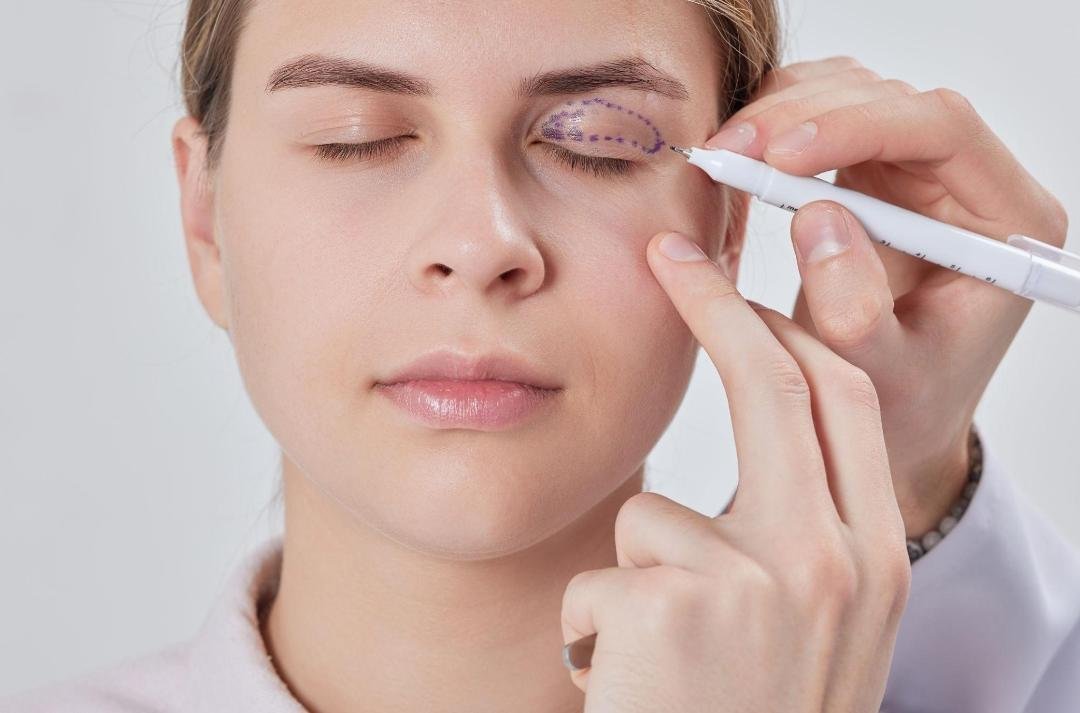 Editorial image representing eye bag surgery (blepharoplasty)
