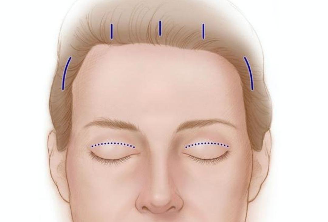 Brow Lift clinical or result imagery