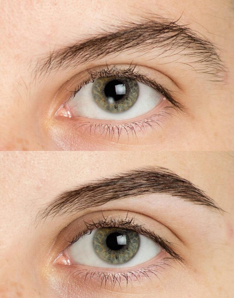 EYEBROW LIFT_2