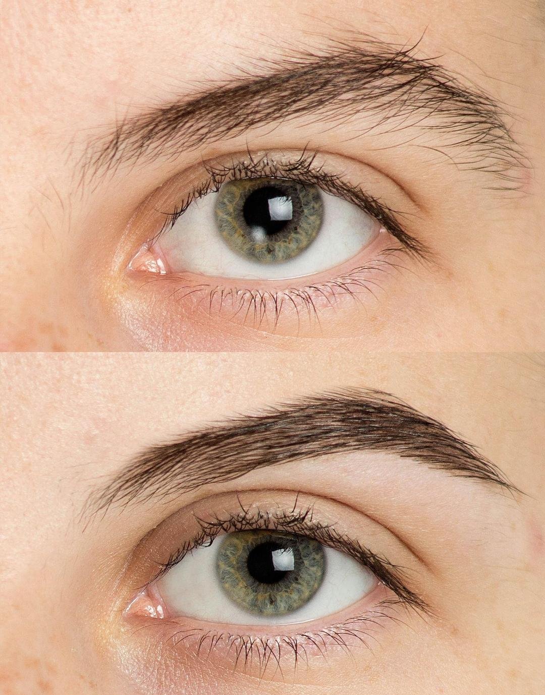Brow Lift clinical or result imagery
