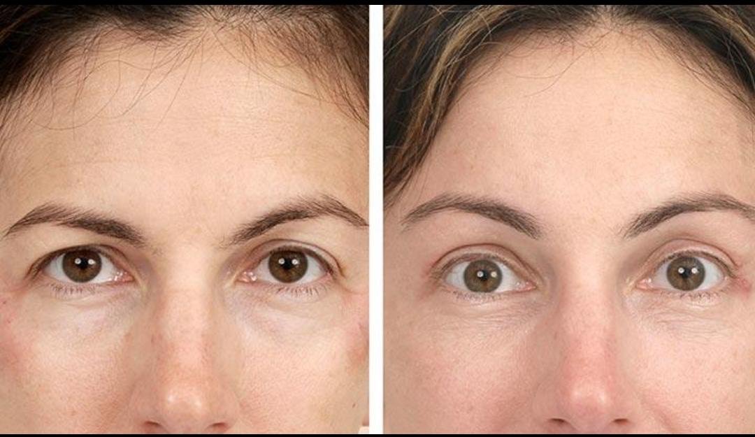 Brow Lift example from the practice media library