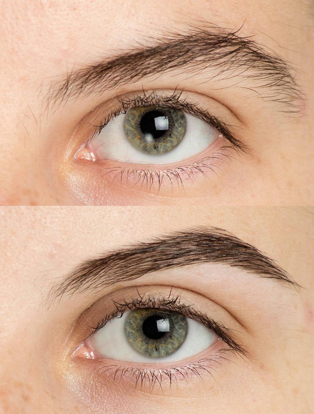 Eyebrow Transplantation clinical or result imagery