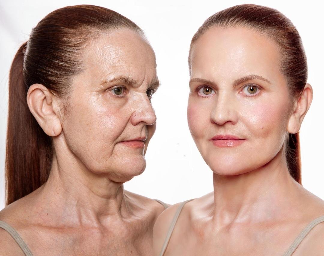 Face Lift (Rhytidectomy) clinical or result imagery