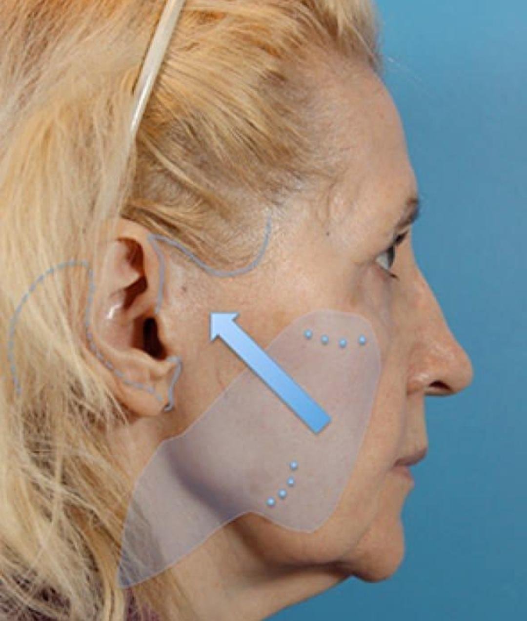 Face Lift (Rhytidectomy) example from the practice media library