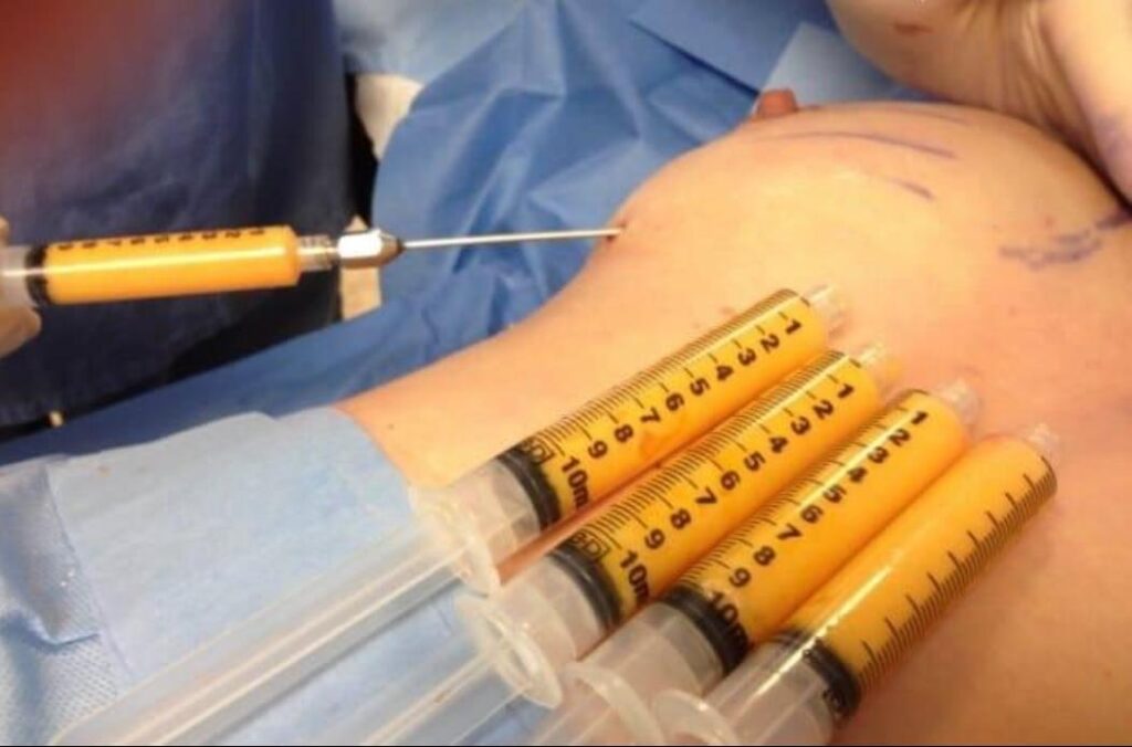 FAT GRAFTING_1