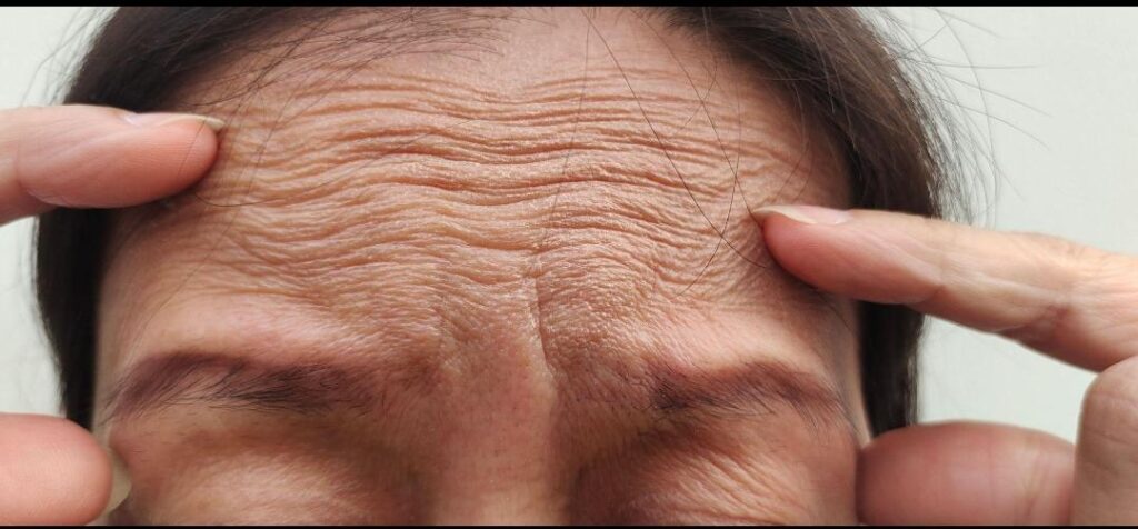 FOREHEAD LIFT_1