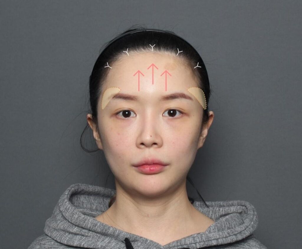 FOREHEAD LIFT_2