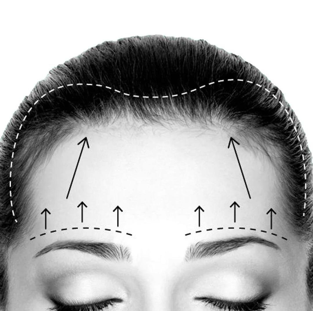 Editorial image representing forehead lift
