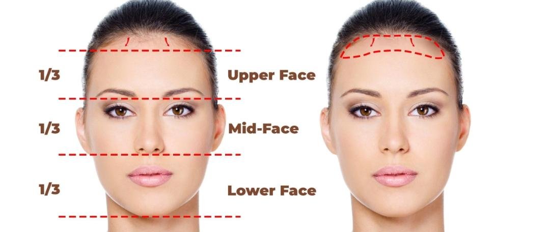 Forehead Reduction / Hairline Lowering clinical or result imagery