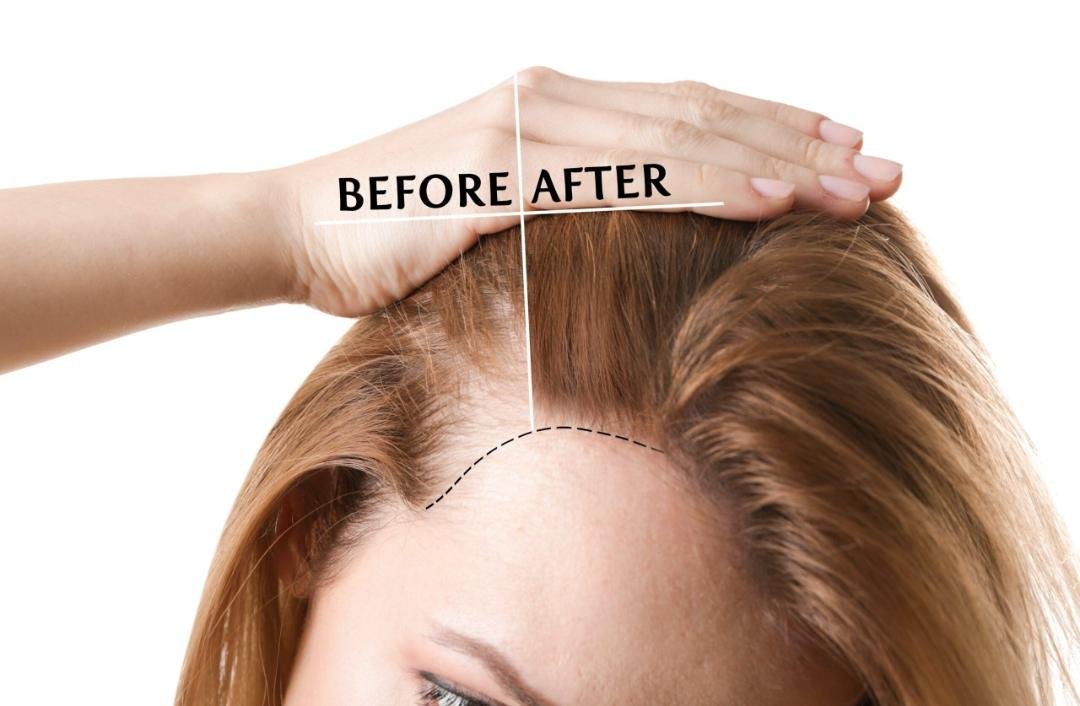 Forehead Reduction / Hairline Lowering example from the practice media library