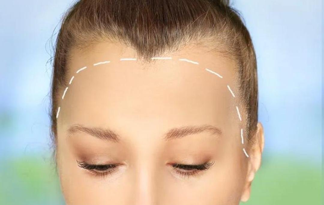 Editorial image representing forehead reduction / hairline lowering