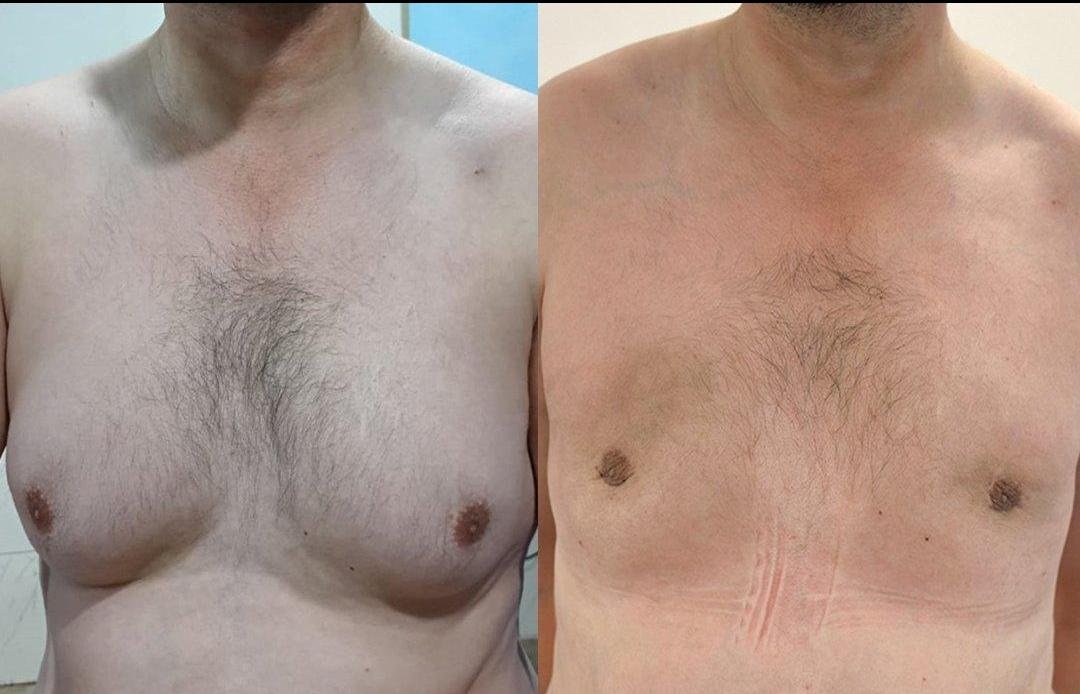 Gynecomastia Surgery clinical or result imagery