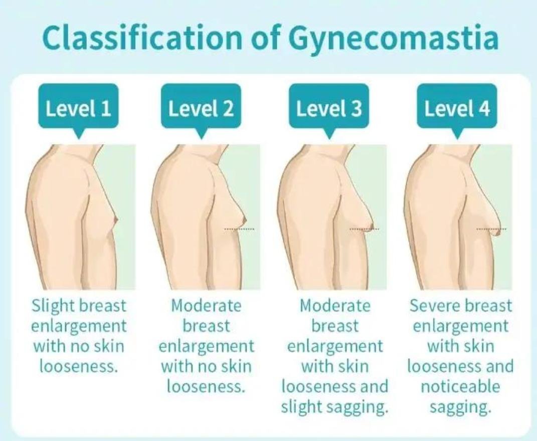 Gynecomastia Surgery clinical or result imagery