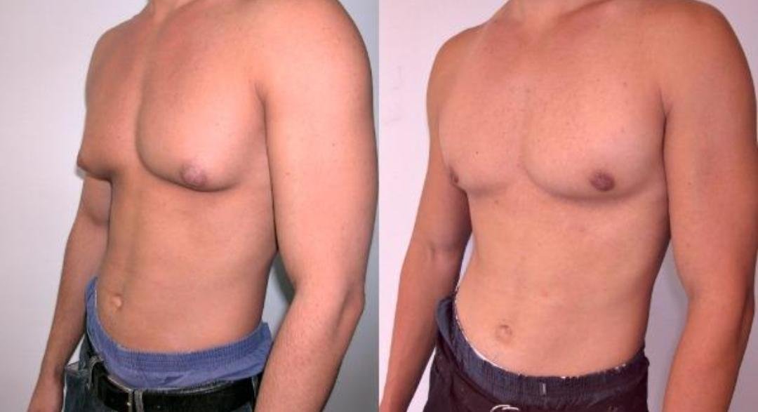 Gynecomastia Surgery example from the practice media library