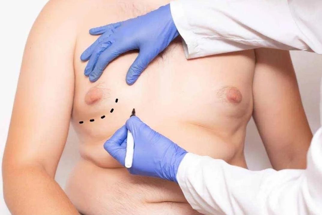 Editorial image representing gynecomastia surgery