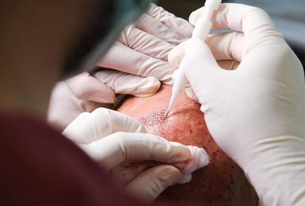 HAIR TRANSPLANTATION-2