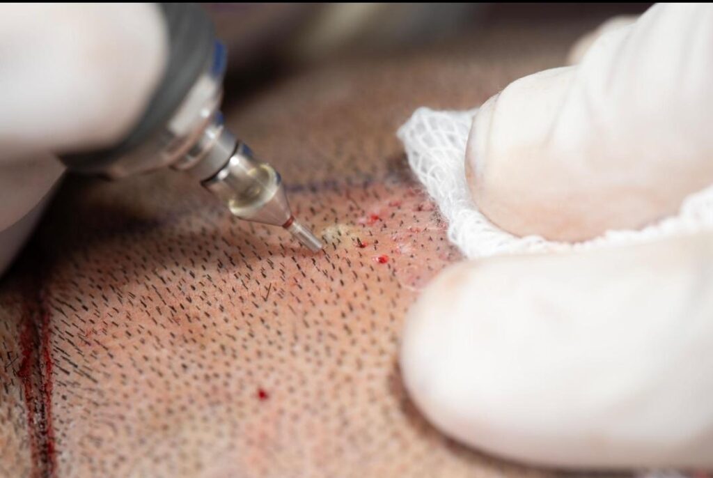 HAIR TRANSPLANTATION-3