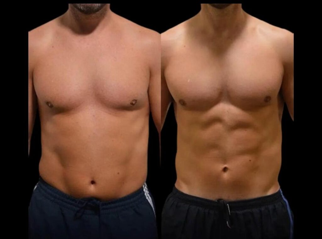 HD liposuction_1