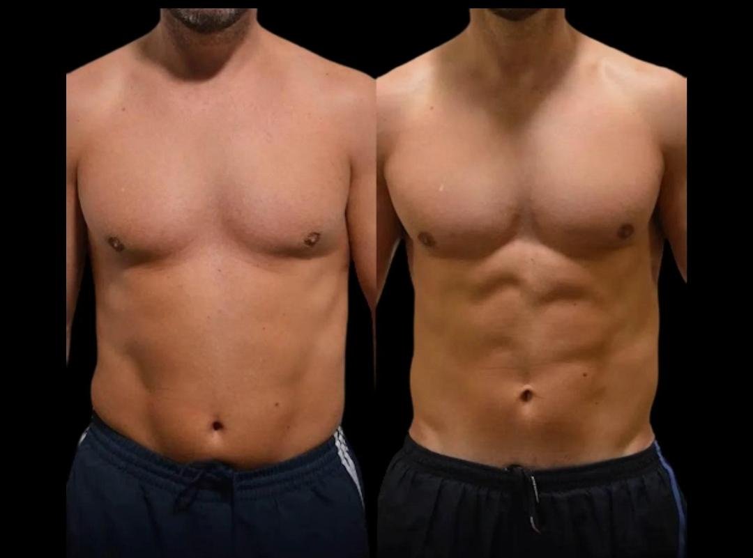 HD Liposuction clinical or result imagery