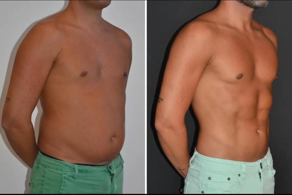 HD liposuction_2