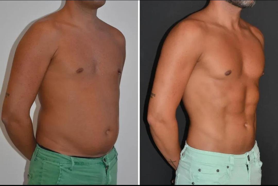 HD Liposuction clinical or result imagery