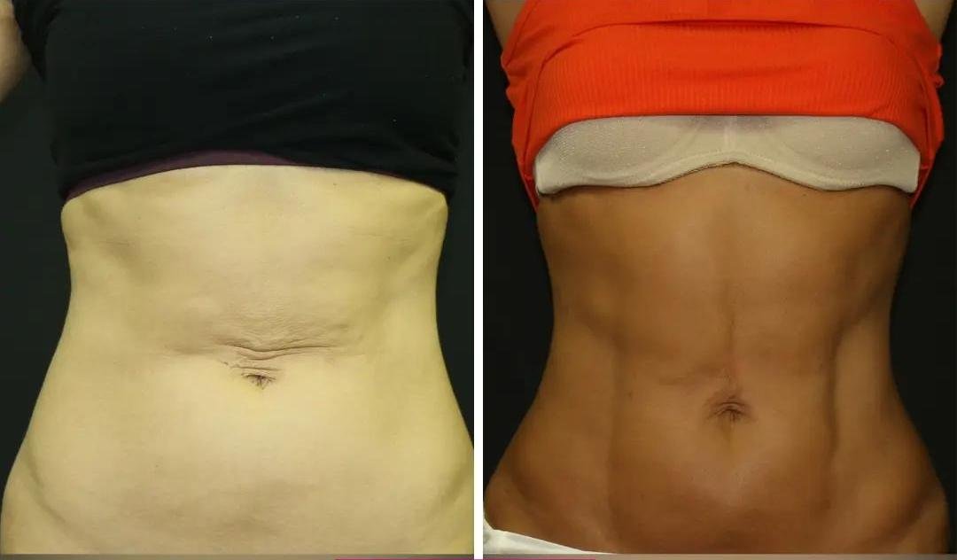 HD Liposuction example from the practice media library