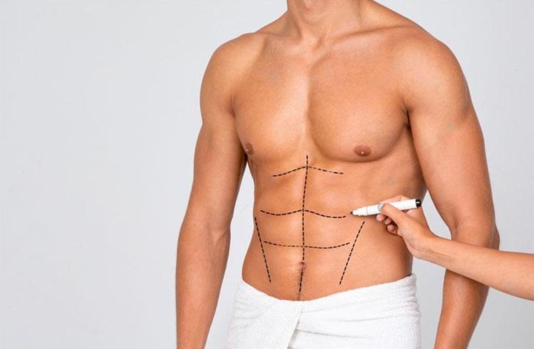 Editorial image representing hd liposuction