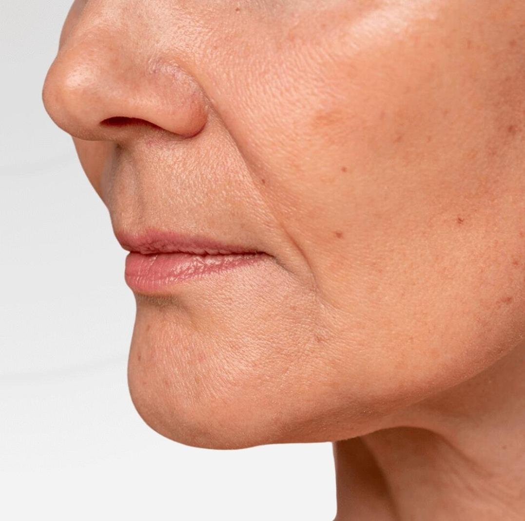 HIFU Skin Tightening clinical or result imagery