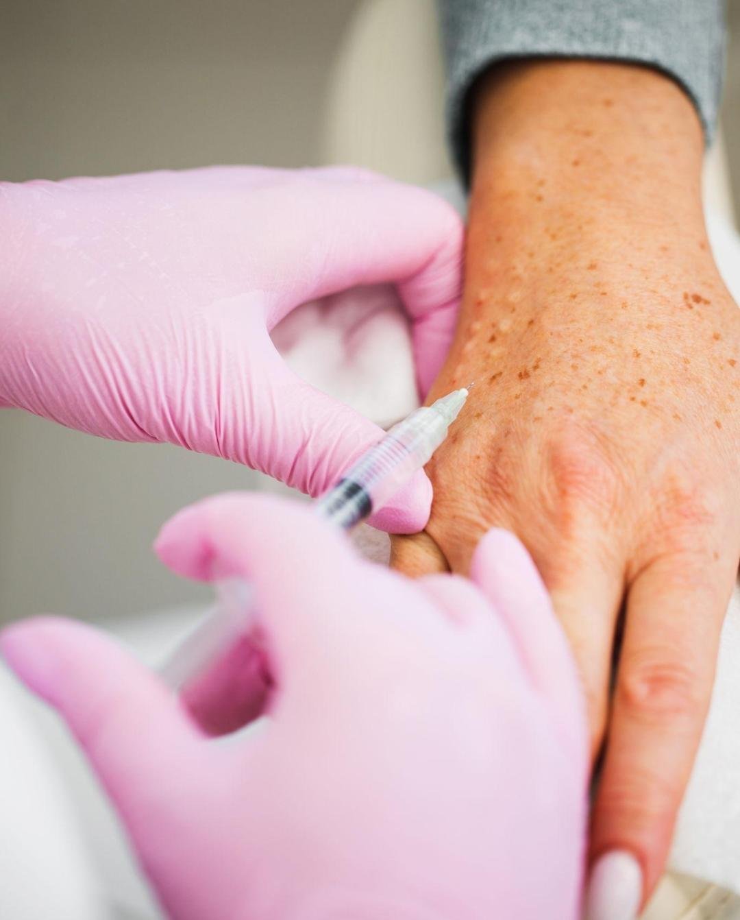 Hand Rejuvenation clinical or result imagery