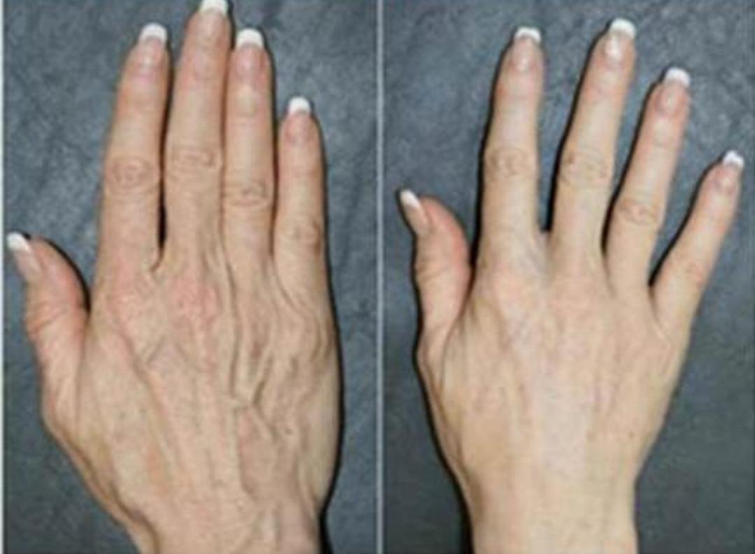 Hand Rejuvenation clinical or result imagery