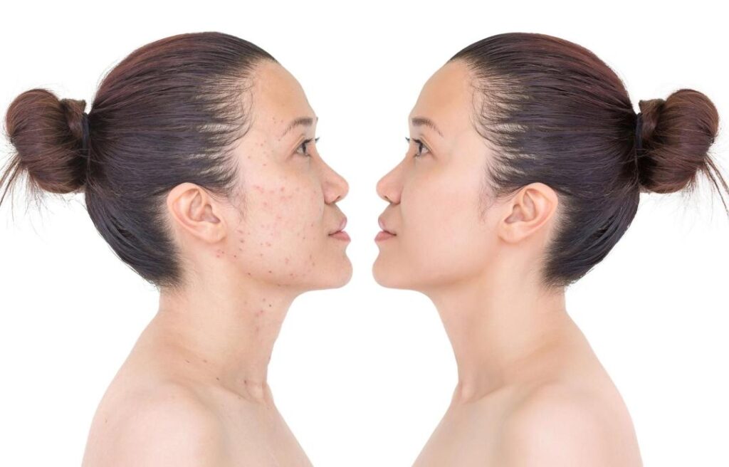 LASER FACIAL_1
