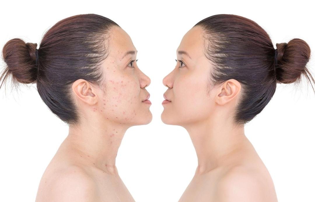 Laser Facial / Laser Skin Treatment clinical or result imagery