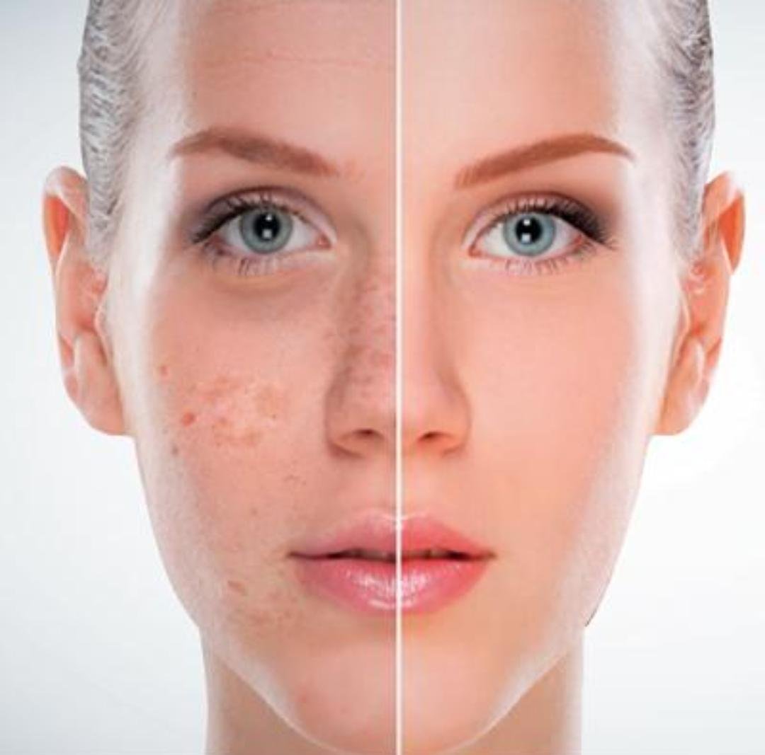 Laser Facial / Laser Skin Treatment example from the practice media library