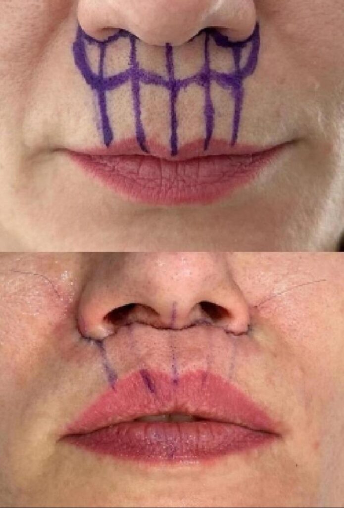 LIP LIFT_1