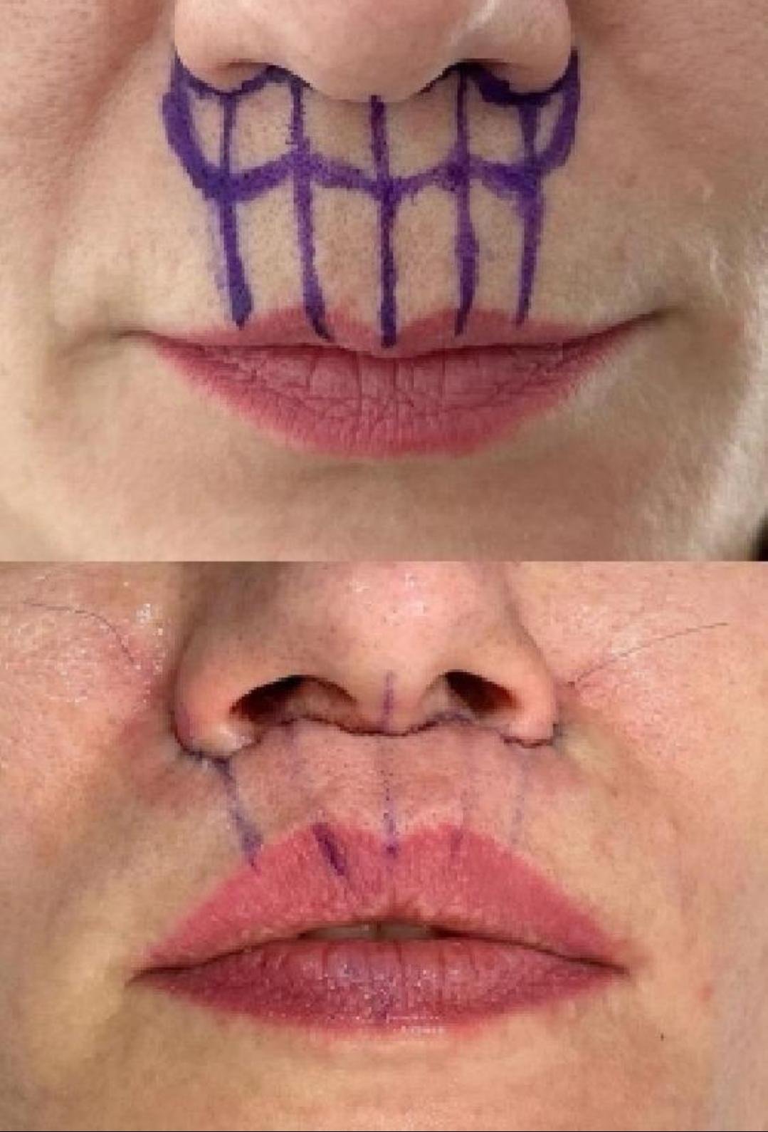 Lip Lift clinical or result imagery