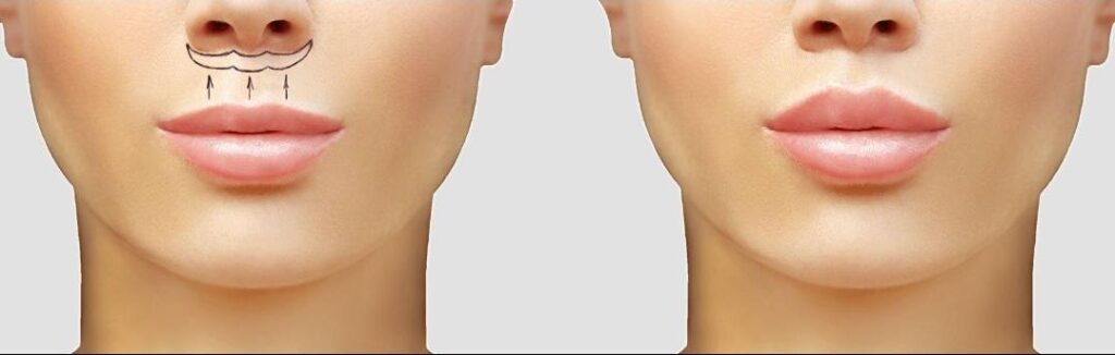 LIP LIFT_2