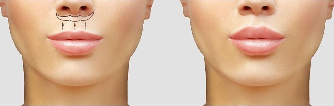 Lip Lift clinical or result imagery