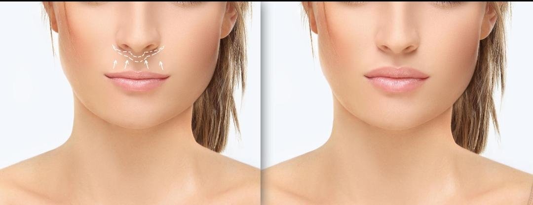 Lip Lift example from the practice media library