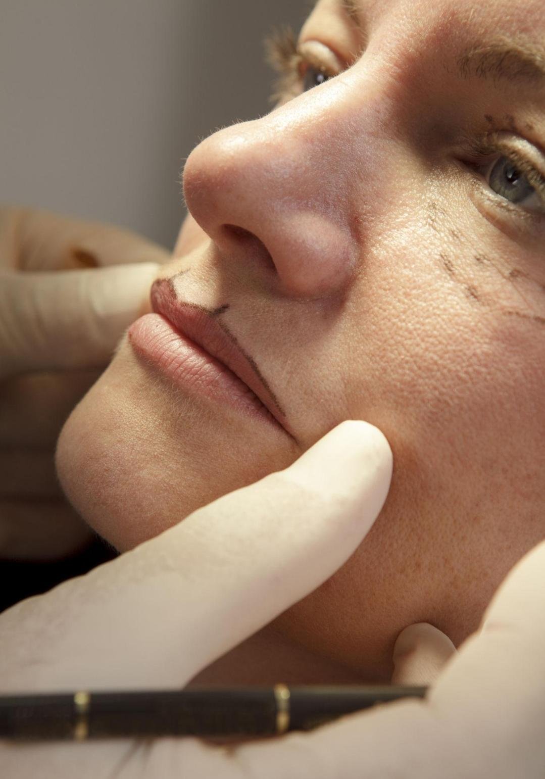 Editorial image representing lip lift