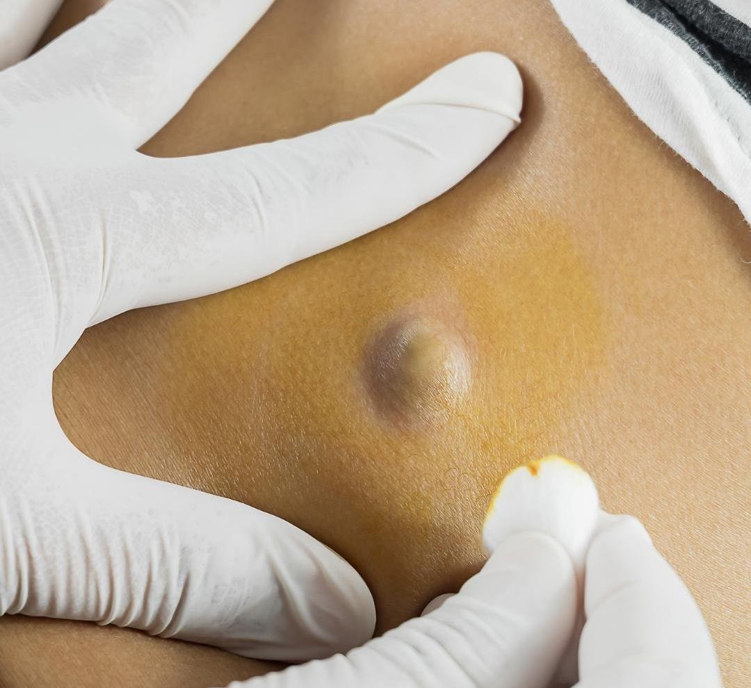 Lipoma Excision clinical or result imagery