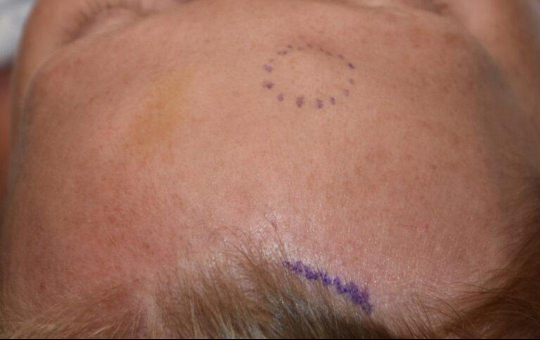 Lipoma Excision example from the practice media library