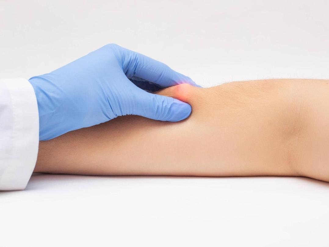 Editorial image representing lipoma excision