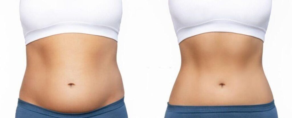 Liposuction _3