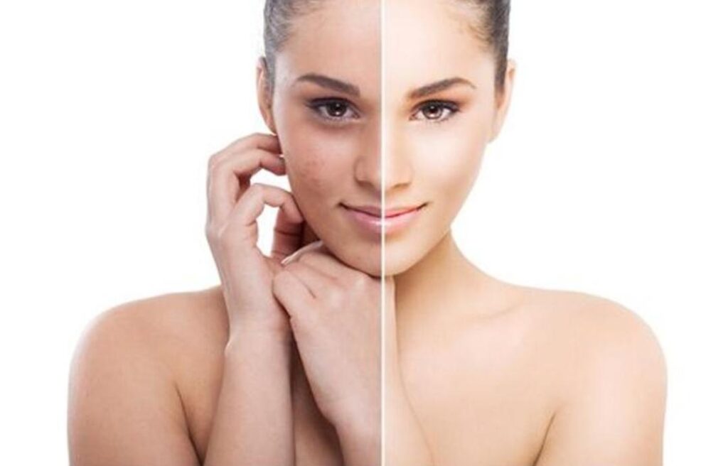 MICRONEEDLING_1