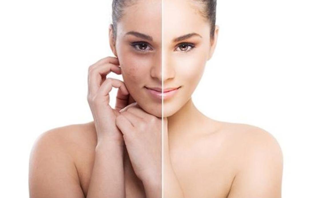 Microneedling clinical or result imagery