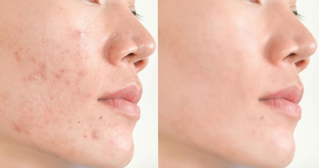 Microneedling clinical or result imagery