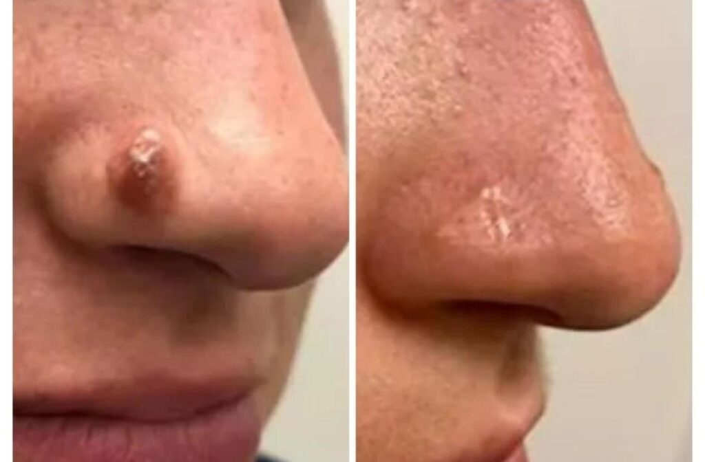MOLES-CYSTS-WARTS_1