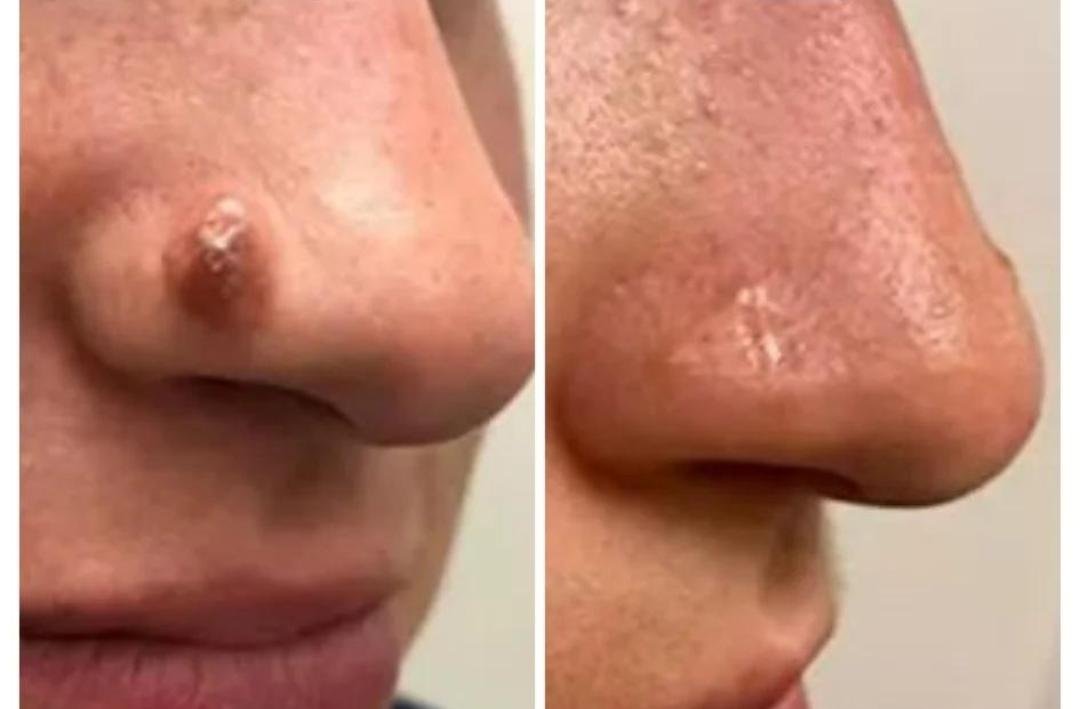 Mole, Cyst & Wart Removal clinical or result imagery