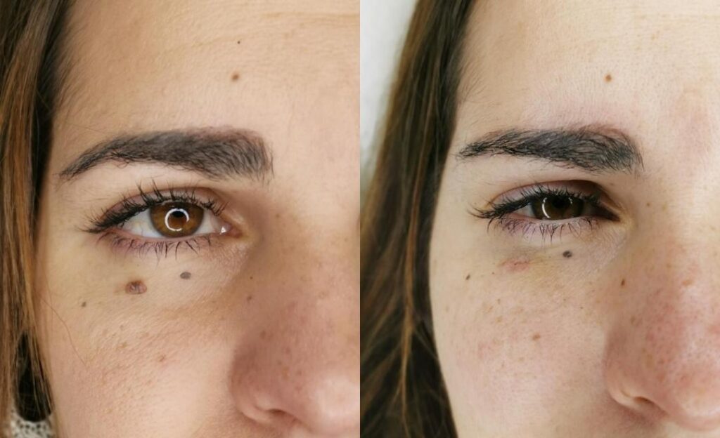 MOLES-CYSTS-WARTS_2