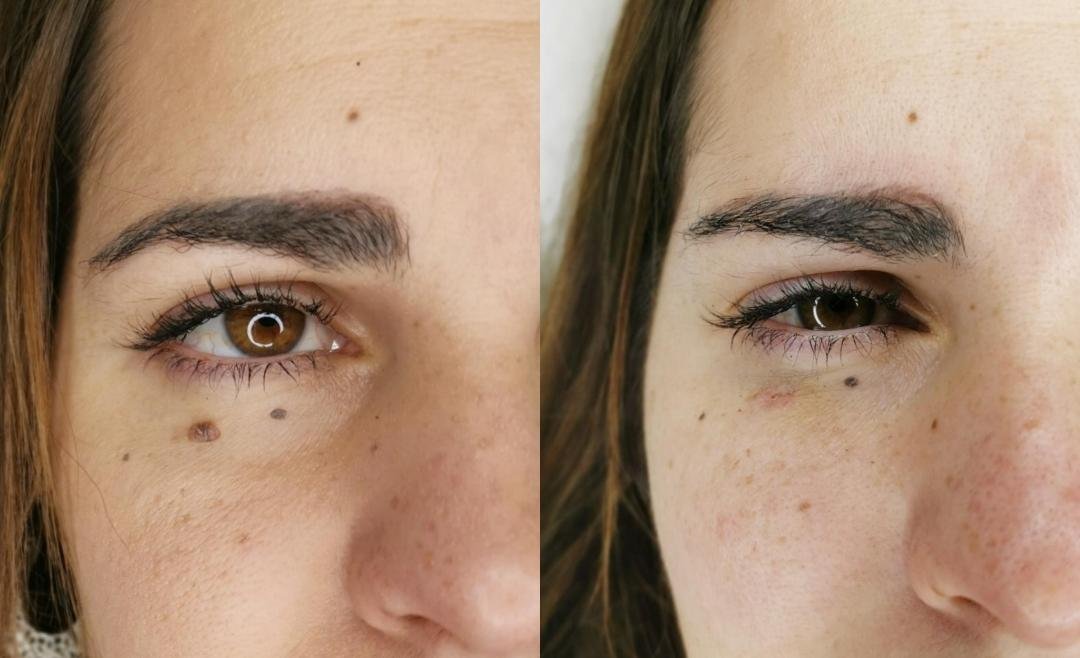 Mole, Cyst & Wart Removal clinical or result imagery
